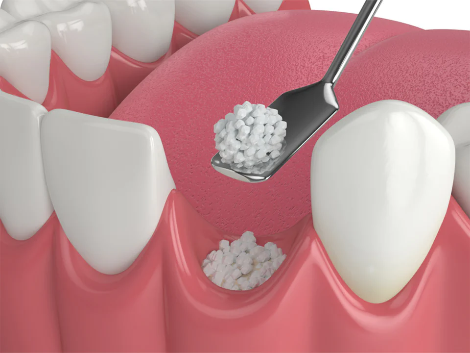 Dental bone grafting at Maldonado Dentistry in Treasure Island, Florida