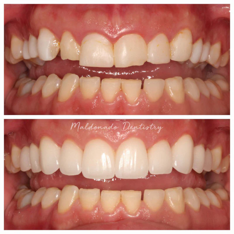 Before and After Restorative Dental Care at Maldonado Dentistry in Treasure Island, Florida