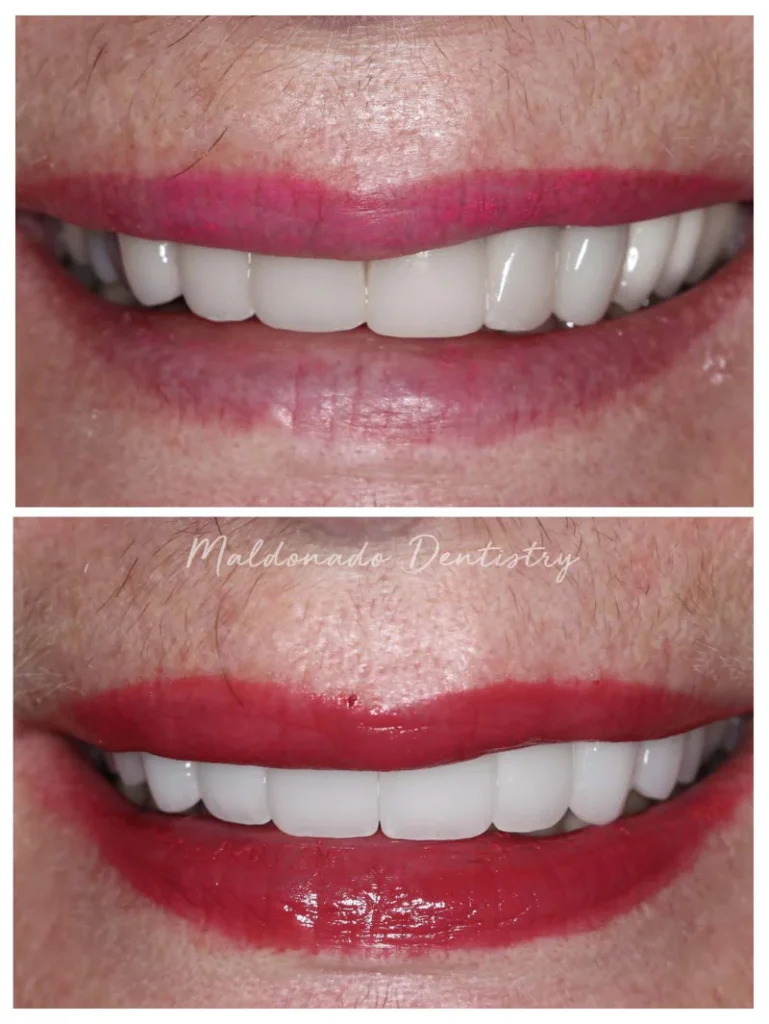 Before and after teeth whitening at Maldonado Dentistry in Treasure Island, Florida