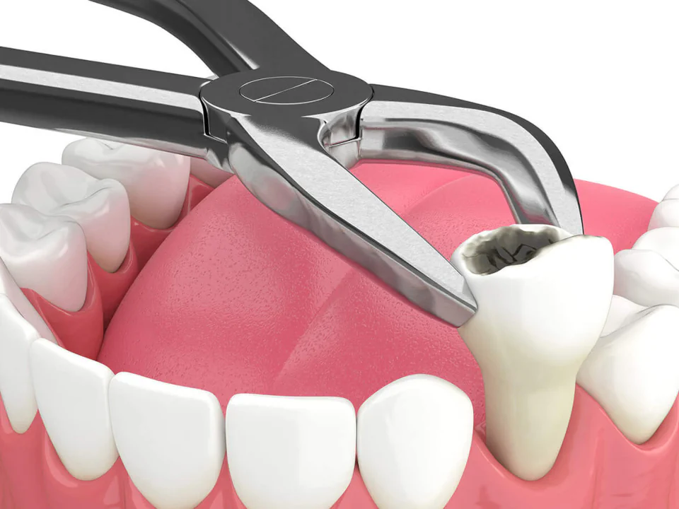 Tooth extraction services at Maldonado Dentistry in Treasure Island, Florida